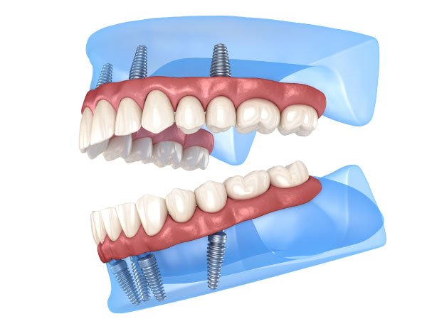 Full Arch Dental Implants in Maple Valley, WA